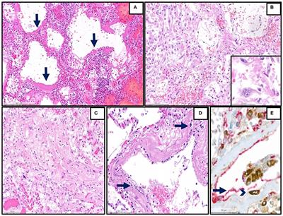 Long-Term Persisting SARS-CoV-2 RNA and Pathological Findings: Lessons Learnt From a Series of 35 COVID-19 Autopsies